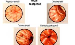 Гастрит гипертрофический: причины, симптомы, лечение
