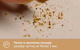 Причины появления песка в желчном пузыре, симптомы, лечение заболевания, в чем риски, основы питания и профилактики