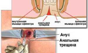 Трещина заднего прохода симптомы и лечение при беременности