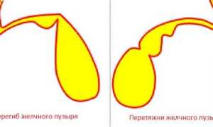Перетяжка желчного пузыря: причины, симптомы и методы лечения