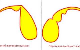 Перетяжка желчного пузыря: причины, симптомы и методы лечения