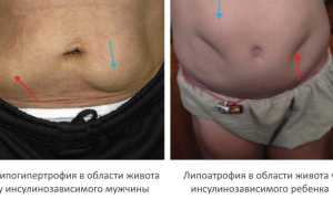 Потеря одного грамма жира из поджелудочной железы может вылечить диабета 2 типа