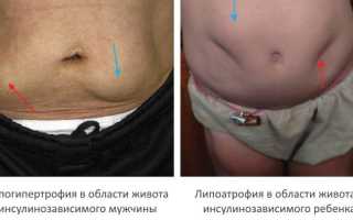 Потеря одного грамма жира из поджелудочной железы может вылечить диабета 2 типа