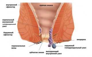 Как лечить геморройные шишки или геморроидальные узлы