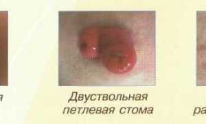 Колостома кишечника — показания к созданию, уход и восстановление