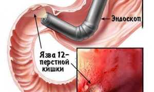 Диагностируем воспаление 12-ти перстной кишки: симптомы