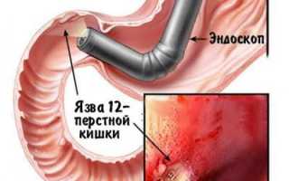 Диагностируем воспаление 12-ти перстной кишки: симптомы
