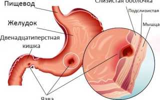 Что делать при открытой язве желудка с кровотечением?