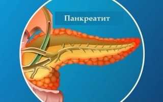 Отечная форма острого панкреатита: диагностика и лечение