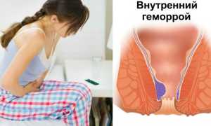Почему перед месячными обостряется геморрой и как быстро вылечить его