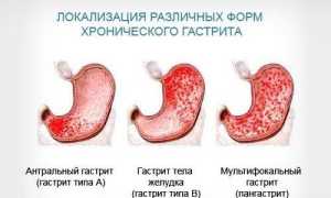 Кофе при гастрите – можно ли пить и как влияет на желудок