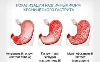 Кофе при гастрите – можно ли пить и как влияет на желудок