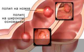 Можно ли вылечить полипы в желудке народными средствами