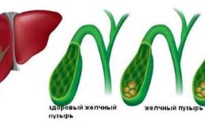 Обострение и лечение хронического холецистита