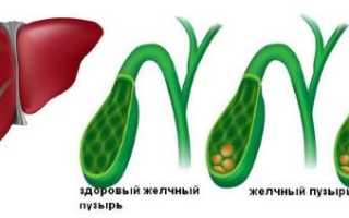 Обострение и лечение хронического холецистита