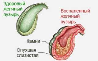 Лучшее в мире средство от камней в желчном пузыре
