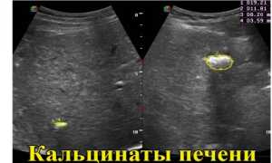 Симптомы, диагностика и лечение кальцината печени
