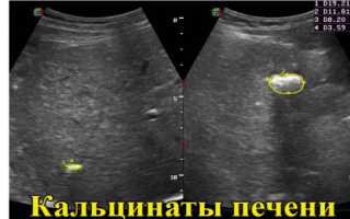 Симптомы, диагностика и лечение кальцината печени