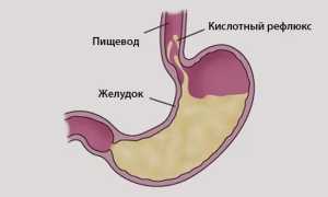 Как вывести желчь из желудка? Медикаментозный подход и лечение средствами народной медицины