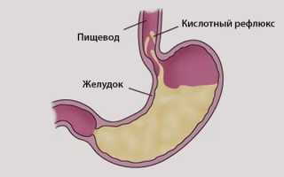 Как вывести желчь из желудка? Медикаментозный подход и лечение средствами народной медицины