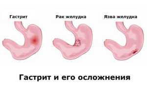 Последствия гастрита. К чему может привести гастрит, если его не лечить?