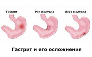Последствия гастрита. К чему может привести гастрит, если его не лечить?