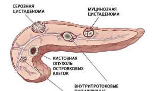 Псевдокиста поджелудочной железы: симптомы, лечение, отзывы пациентов