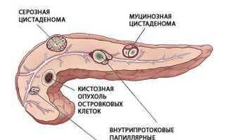 Псевдокиста поджелудочной железы: симптомы, лечение, отзывы пациентов
