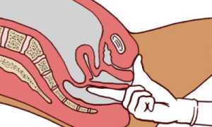 Как лечить геморрой у подростка – эффективные методы и средства