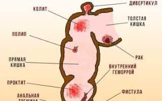 Народные средства для лечения кровоточащего геморроя