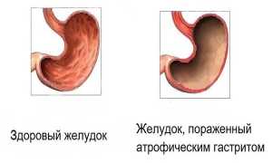 Можно ли цикорий при язве двенадцатиперстной кишки