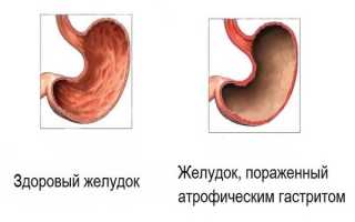 Можно ли цикорий при язве двенадцатиперстной кишки