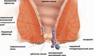 5 способов лечения геморроя содой и советы профессора Неумывакина