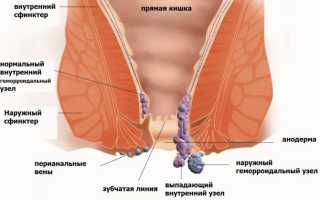 5 способов лечения геморроя содой и советы профессора Неумывакина