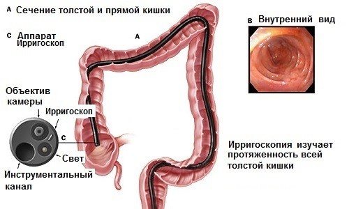 Ирригоскопия кишечника