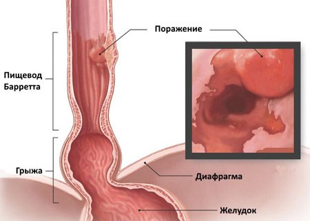 Изжога в горле: причины, симптомы и лечение