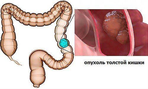 Опухоль кишечника