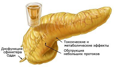Поджелудочная железа и алкоголь