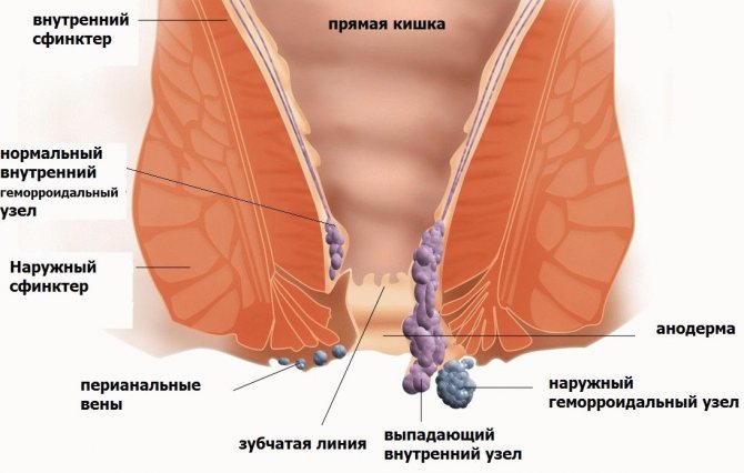 Строение геморроя