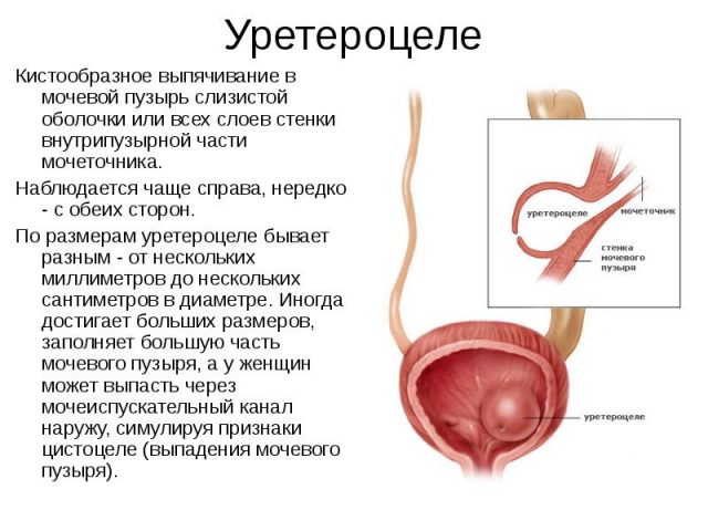 Уретероцеле